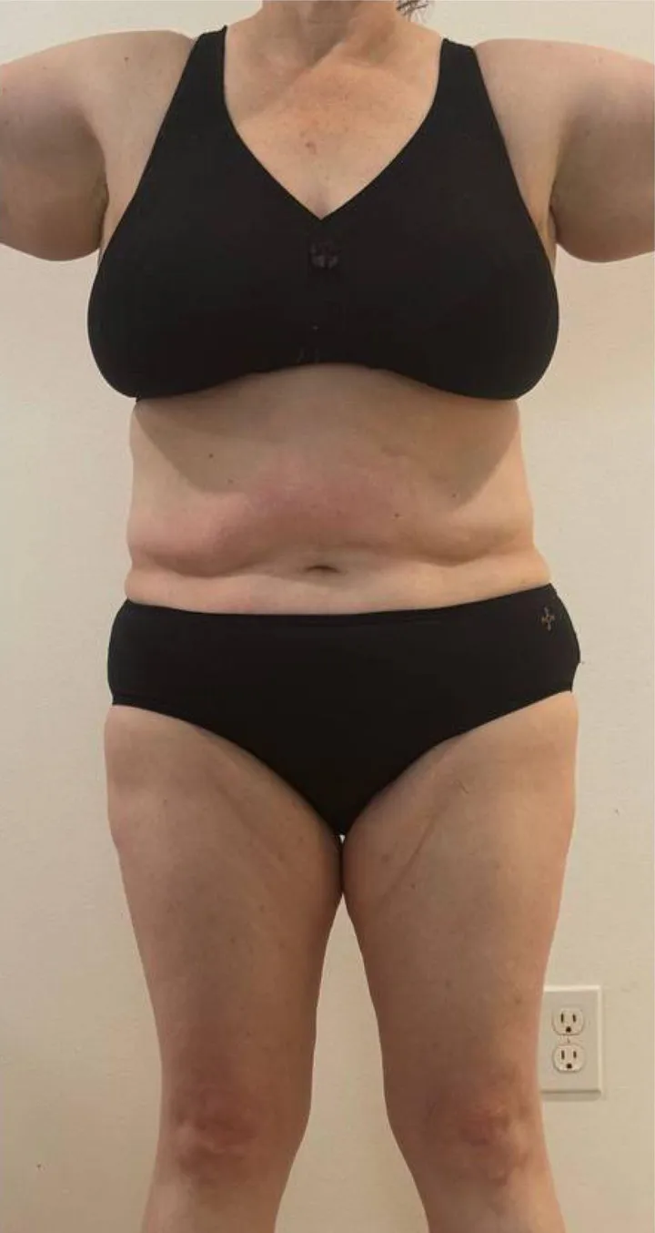 After 12 sessions of Endospheres treatment — Improved skin elasticity