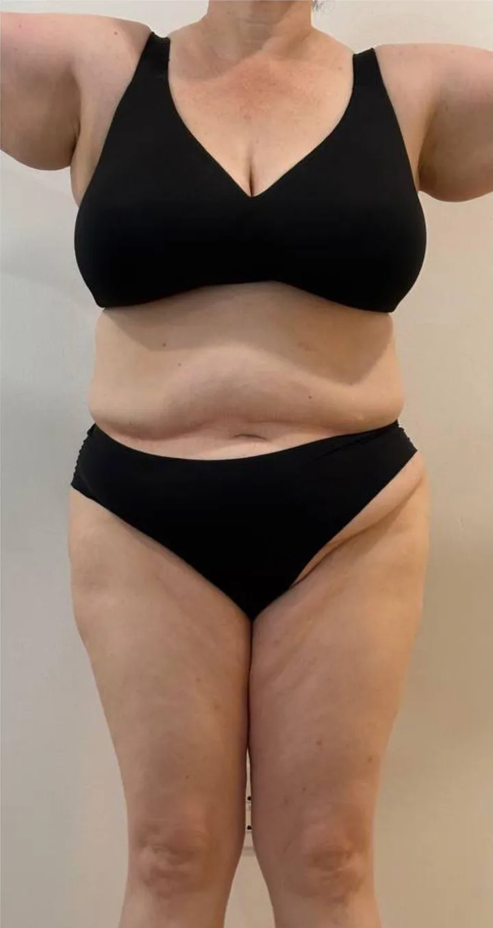 Before Endospheres body sculpting treatment at REVIKA