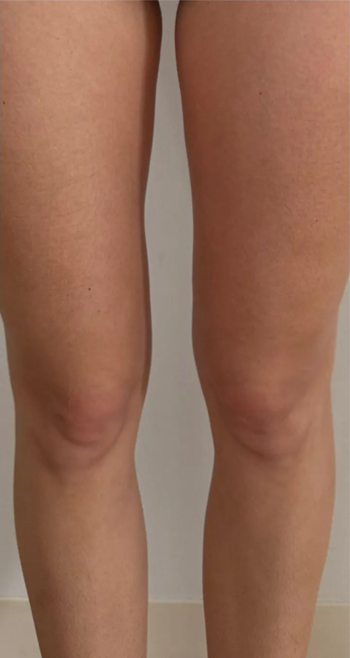 After 3 sessions of Endospheres treatment — Improved skin elasticity in the knee area