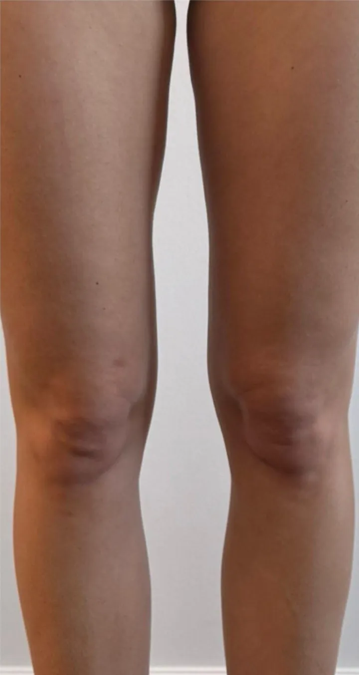 Before Endospheres body sculpting treatment at REVIKA