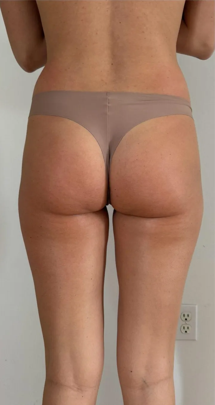 After 3 sessions of Endospheres treatment — Reduced cellulite, toned skin