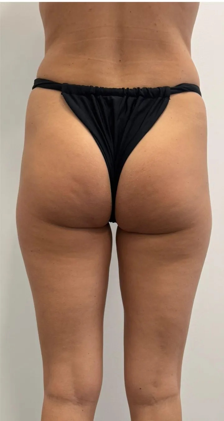Before Endospheres body sculpting treatment at REVIKA