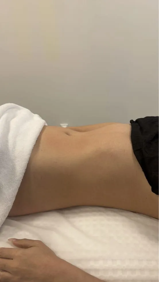After 1 session of Endospheres treatment