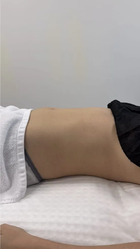 Before Endospheres body sculpting treatment at REVIKA