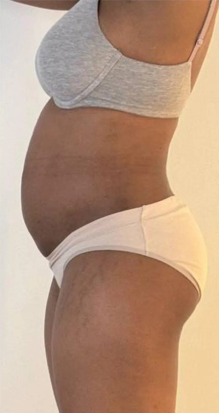 Before Endospheres body sculpting treatment at REVIKA