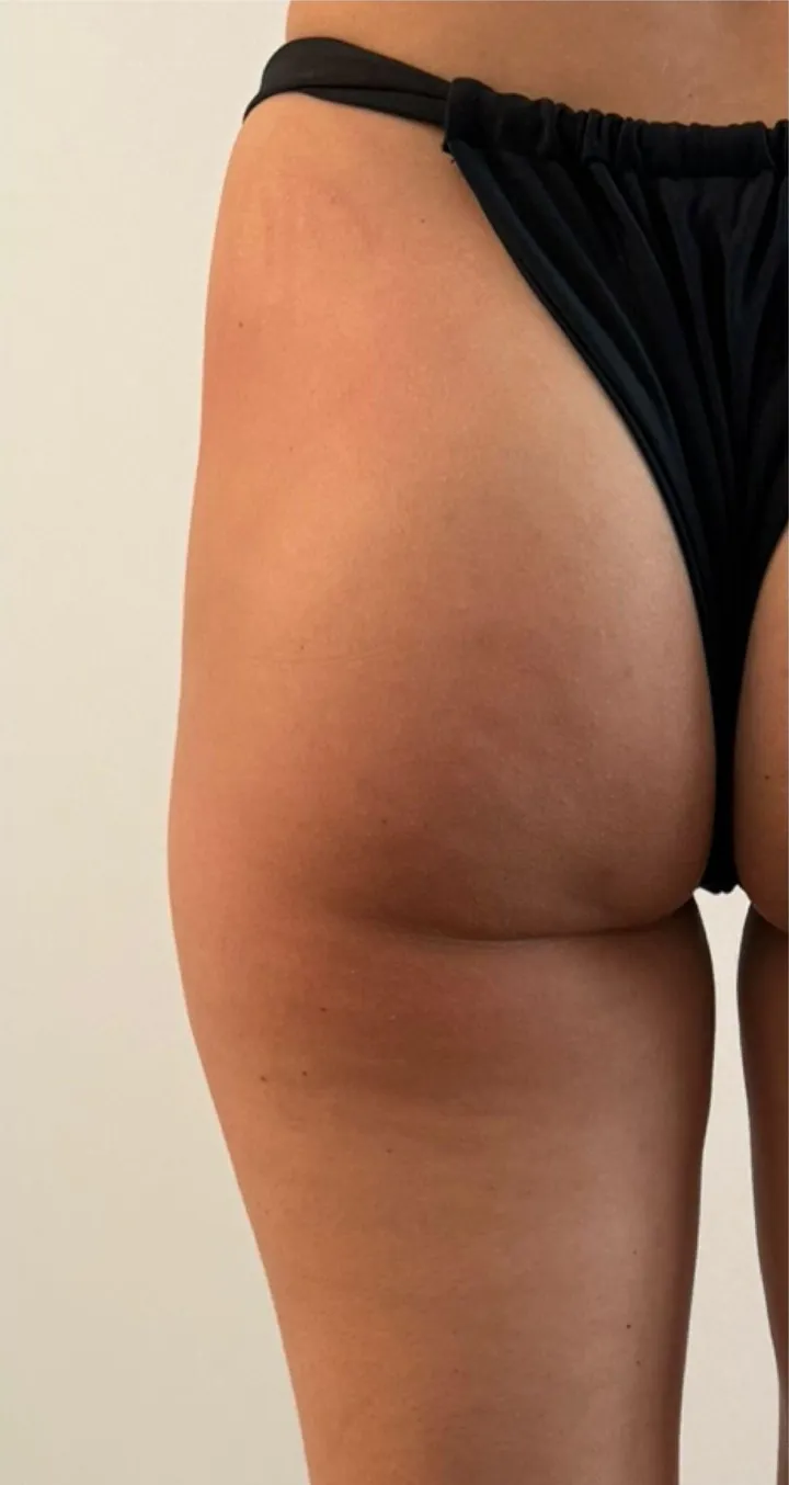 After 1 session of Endospheres treatment — Reduced cellulite, toned skin