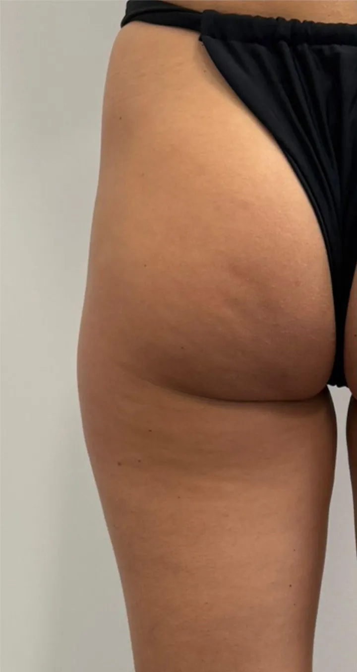 Before Endospheres body sculpting treatment at REVIKA