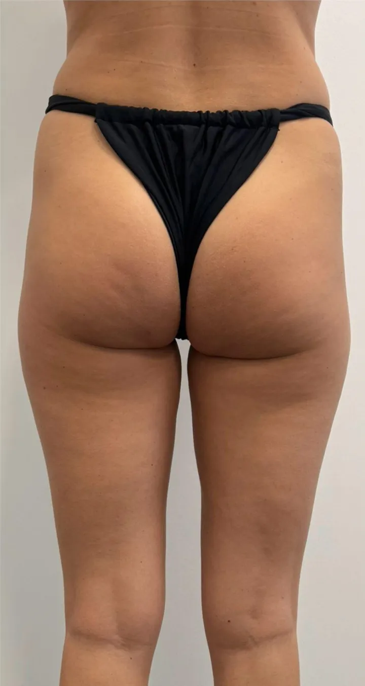 Before Endospheres body sculpting treatment at REVIKA