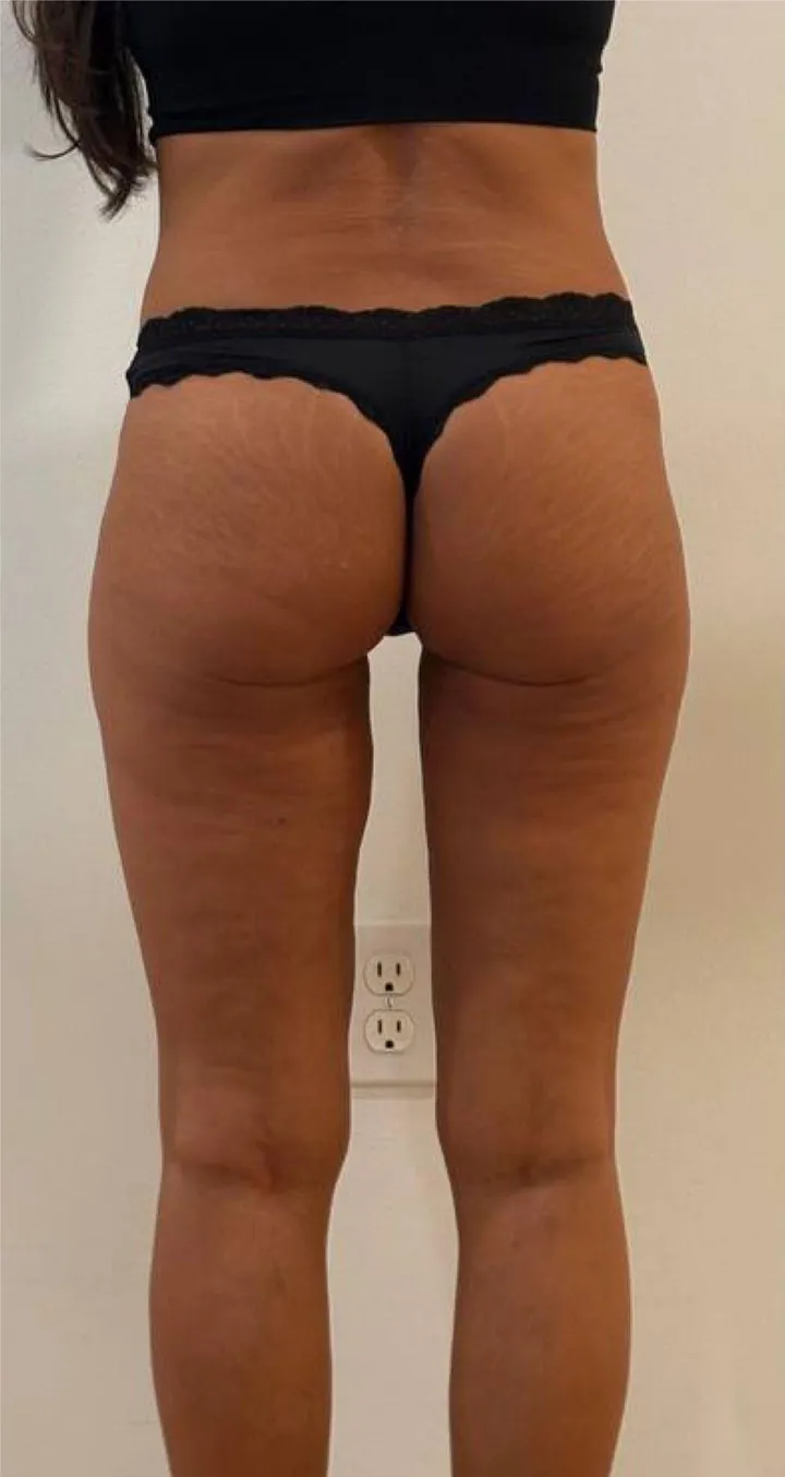 Before Endospheres body sculpting treatment at REVIKA
