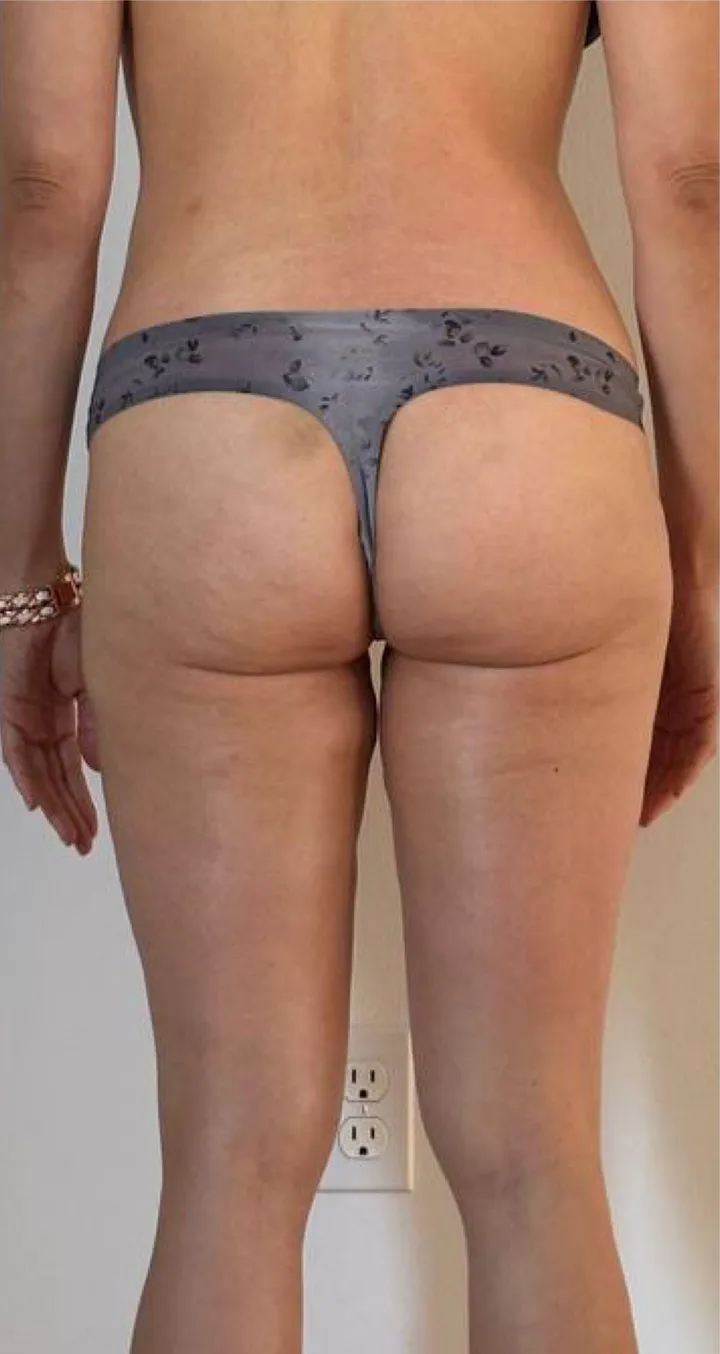 After 6 sessions of Endospheres treatment — Smoother skin texture, reduced cellulite