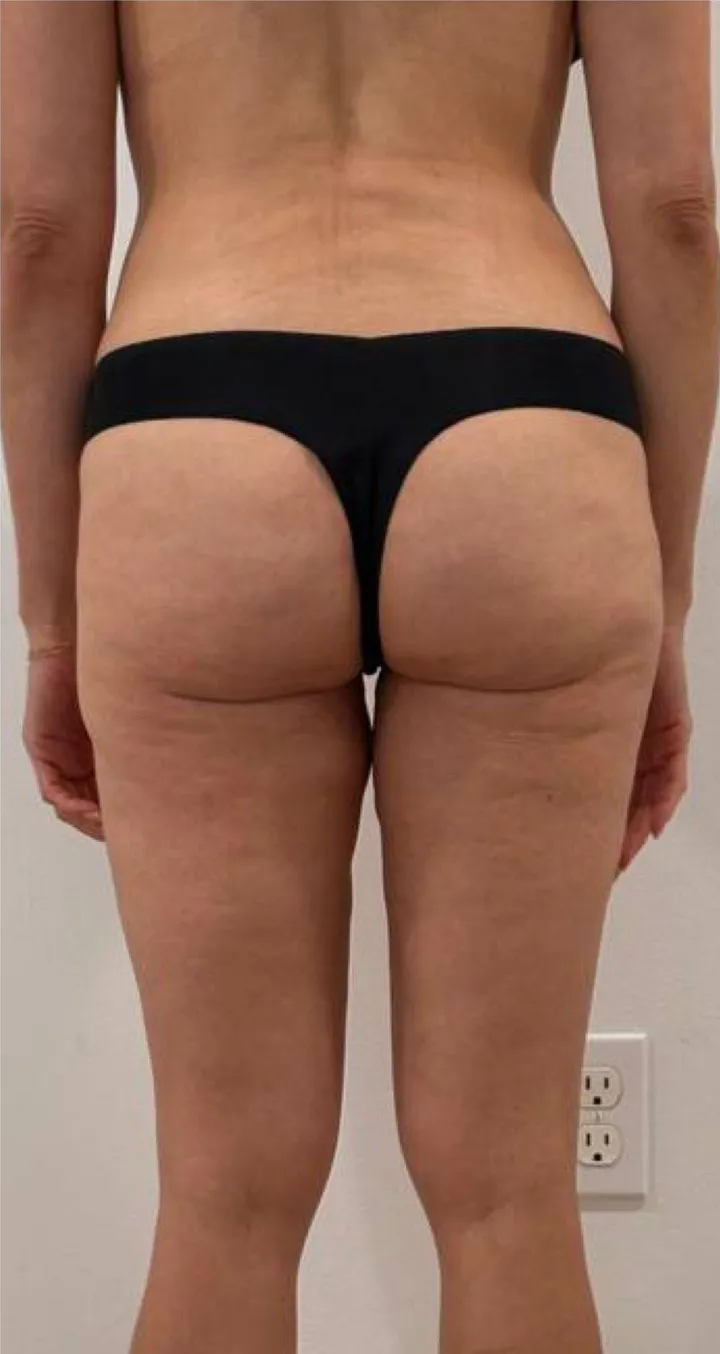 Before Endospheres body sculpting treatment at REVIKA