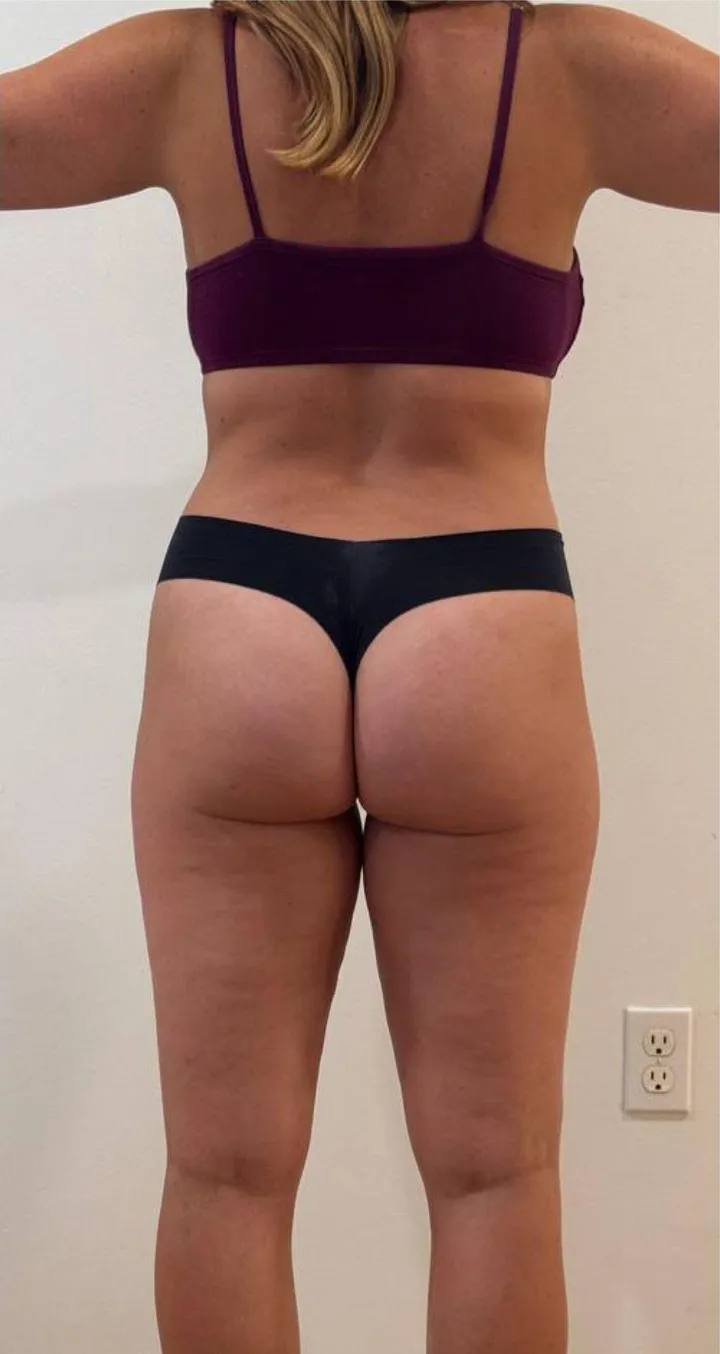 After 6 sessions of Endospheres treatment — Restored lymphatic flow, reduced puffiness and volume