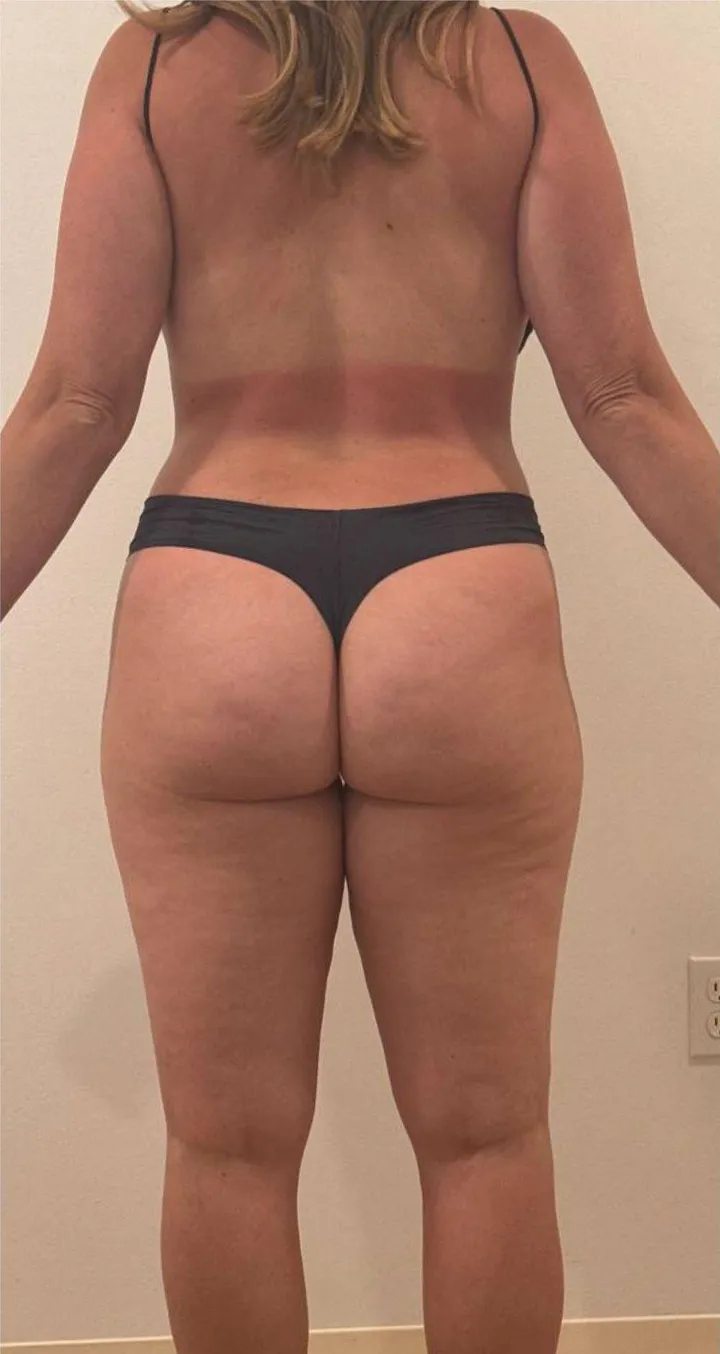 Before Endospheres body sculpting treatment at REVIKA