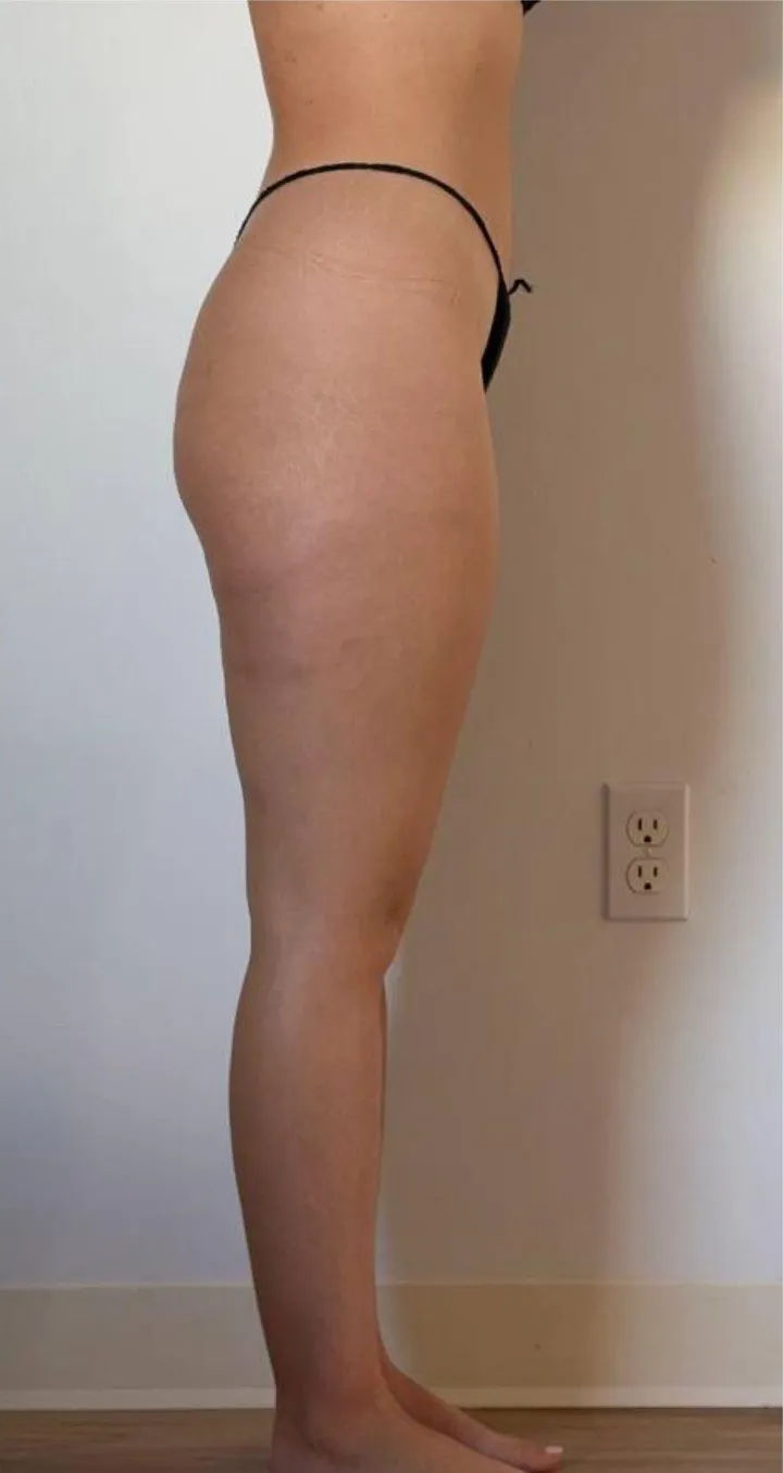 After 6 sessions of Endospheres treatment — Reduced cellulite appearance