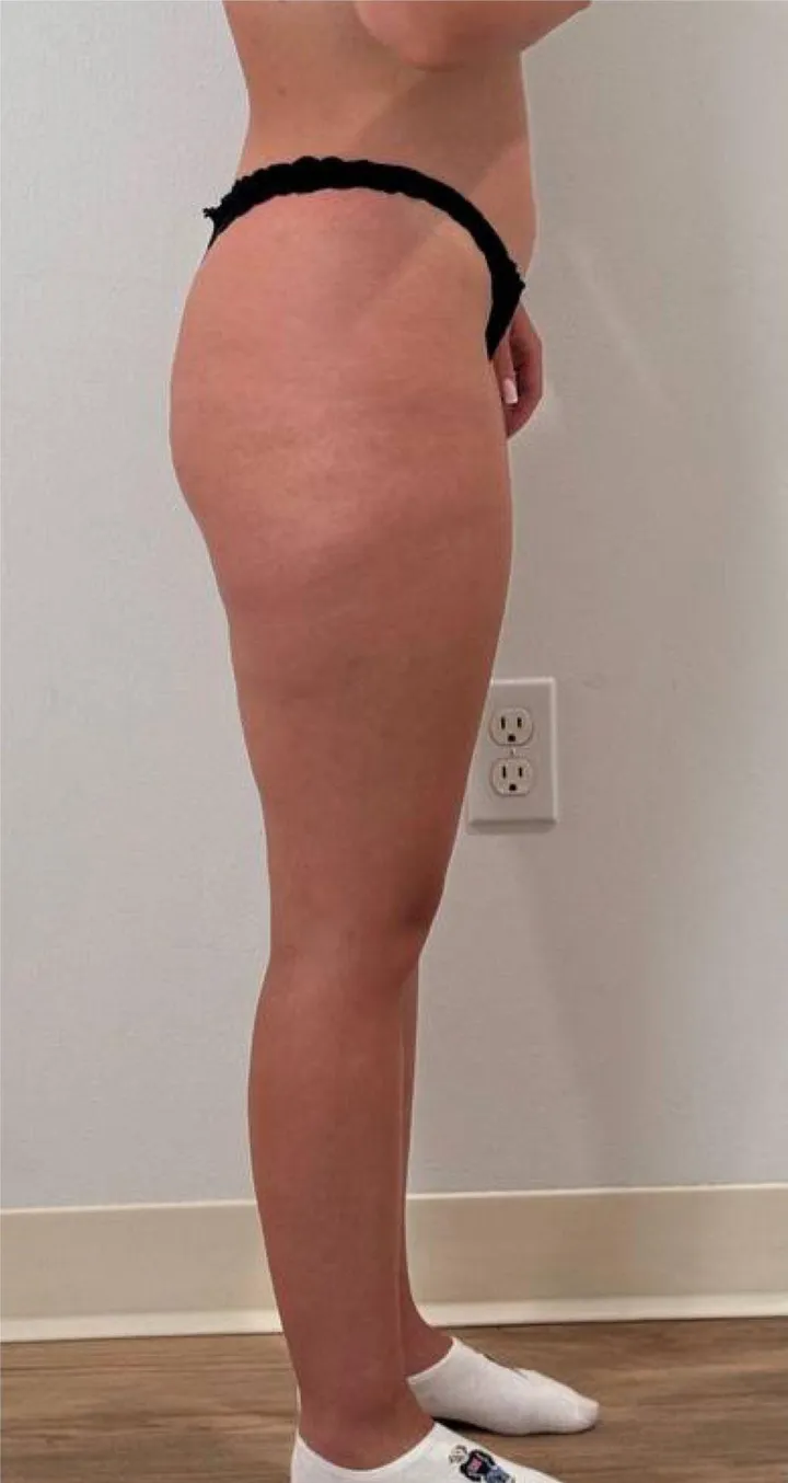 Before Endospheres body sculpting treatment at REVIKA