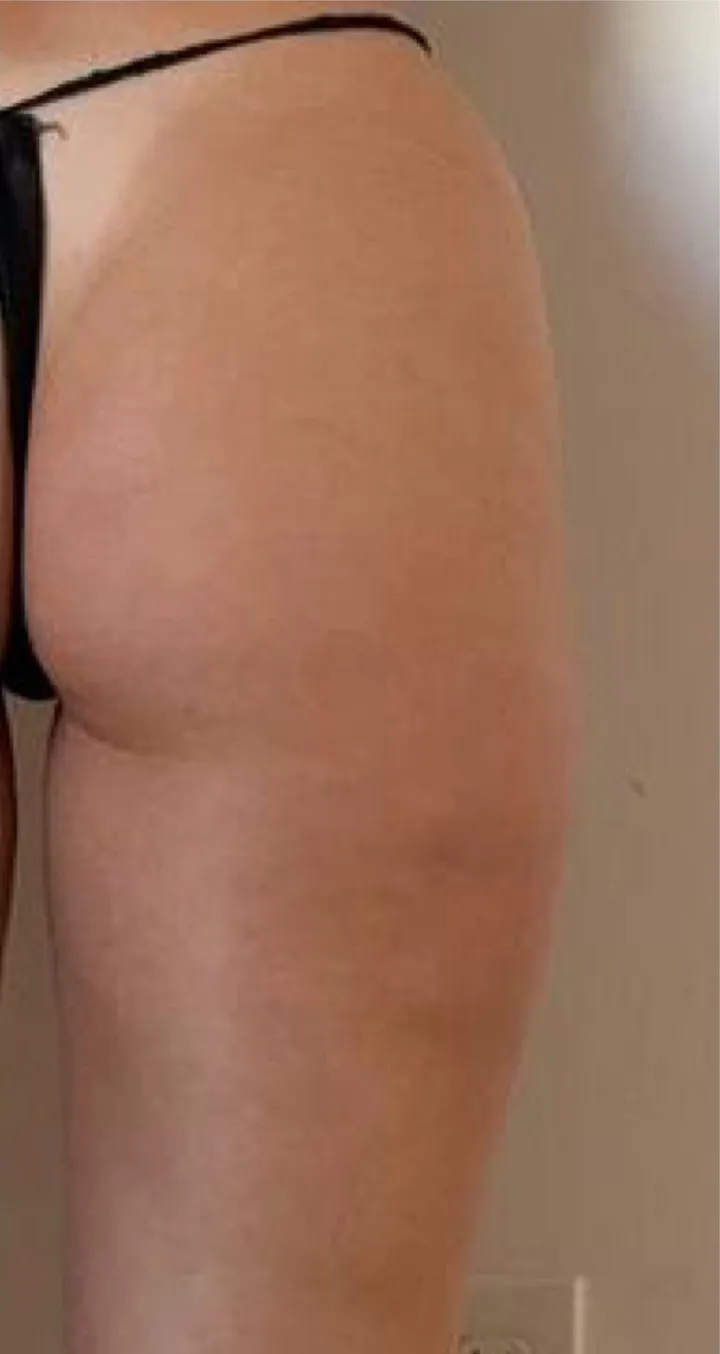 After 6 sessions of Endospheres treatment — Reduced cellulite appearance
