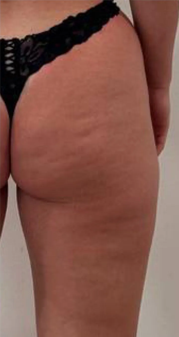 Before Endospheres body sculpting treatment at REVIKA