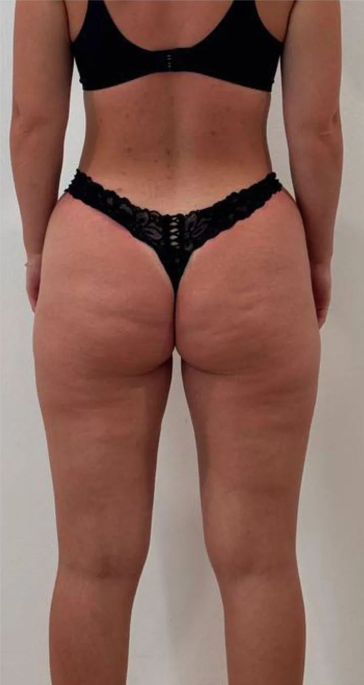 Before Endospheres body sculpting treatment at REVIKA