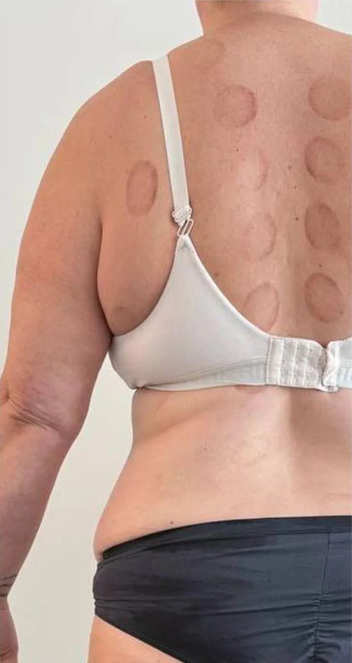 After 12 sessions of Endospheres treatment — Restored lymphatic flow, volume reduction