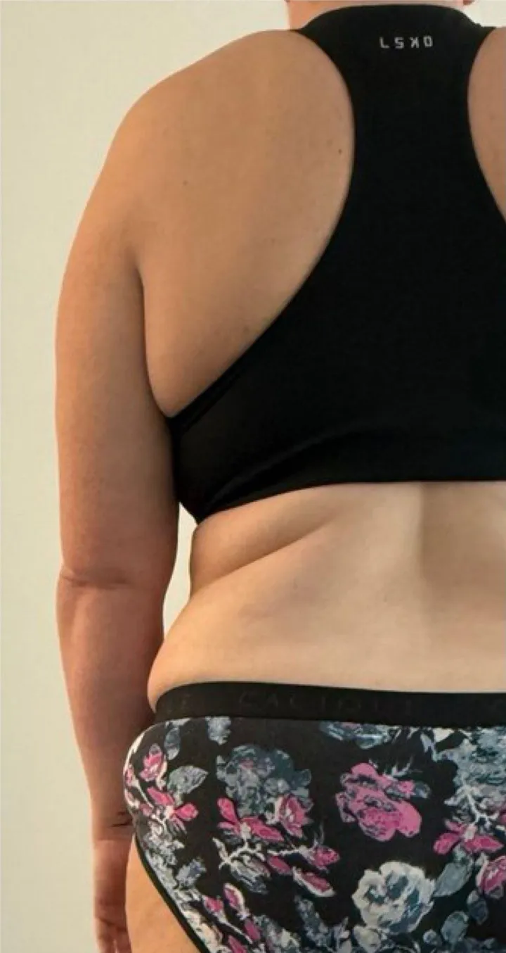 Before Endospheres body sculpting treatment at REVIKA